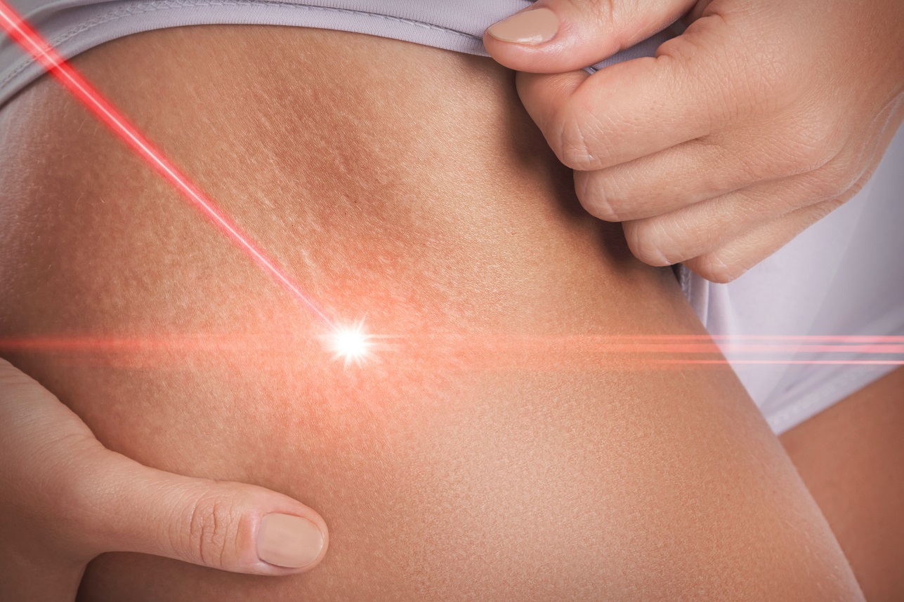Close-up,Of,Female,Hips,With,A,Stretch,Marks,During,Laser