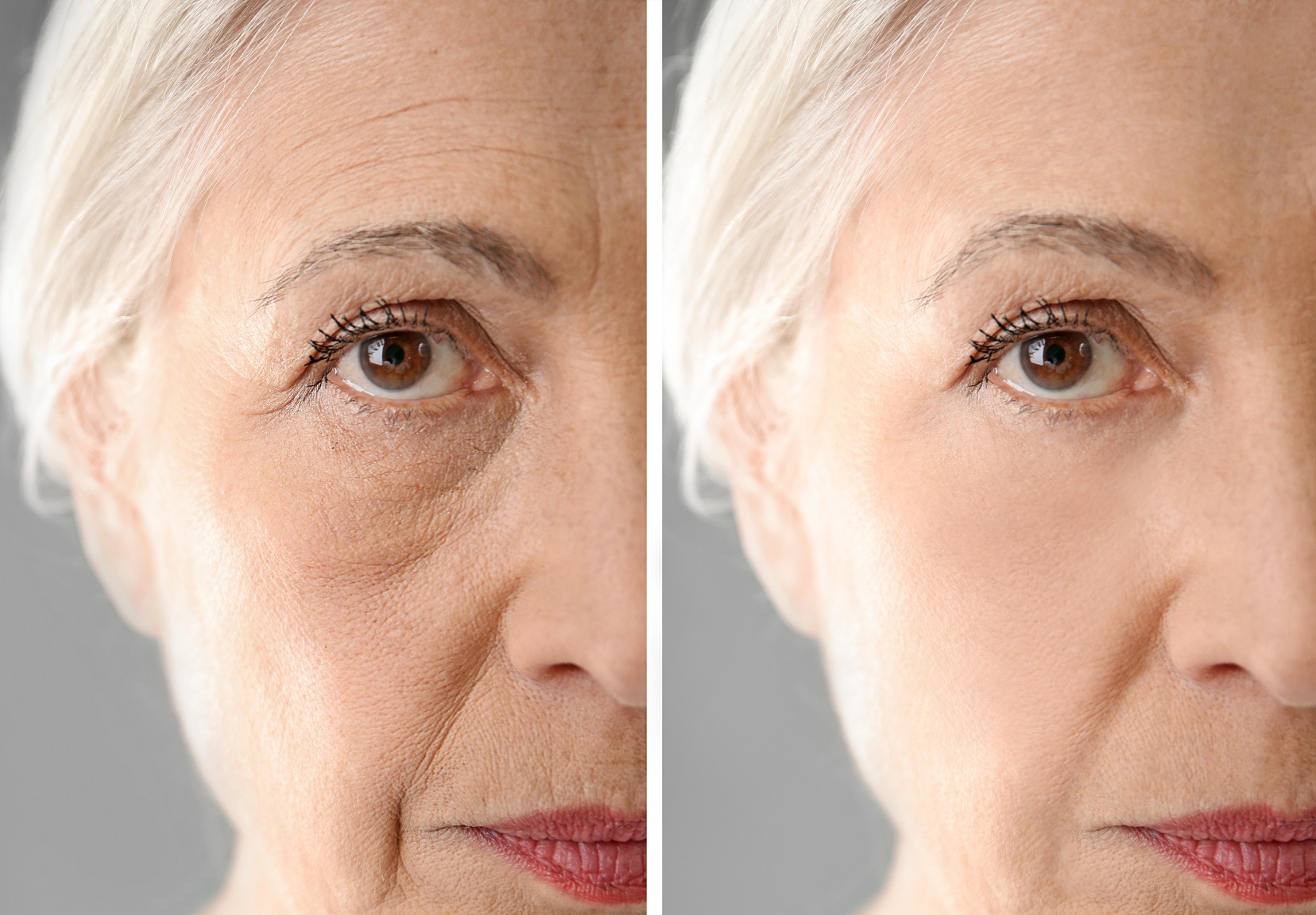 Senior,Woman,Before,And,After,Biorevitalization,Procedure,,Closeup